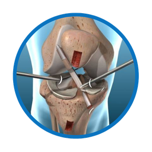 arthroscopy